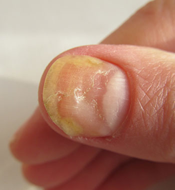 Nail Fungus - Richmond Dermatology