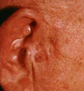 Skin Cancers Actinic Keratosis