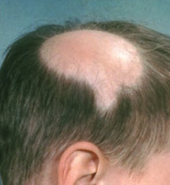 Alopecia Areata - Richmond Dermatology