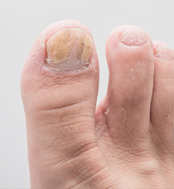 Nail Psoriasis - Richmond Dermatology