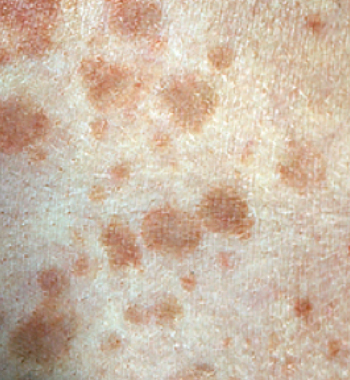 Tinea Versicolor - Richmond Dermatology