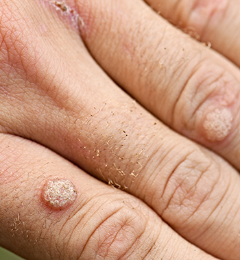 Warts Richmond Dermatology